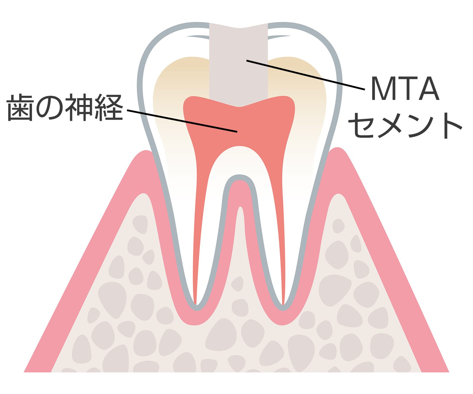 歯髄を残す治療のイメージ図